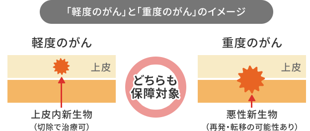 「軽度のがん」と「重度のがん」のイメージ